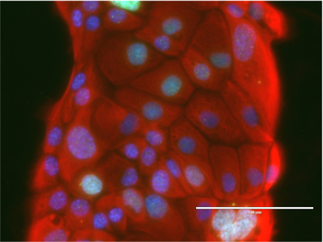 Advanced imaging and microscopic techniques that make cellular components visible help researchers tease apart the highly complex interactions of signaling pathways that govern the lives of cells, in both healthy and cancerous tissues. Understanding the various components of such interactions provides the basis for the development of more effective therapeutic approaches. (Photo: Witkiewicz lab) Advanced imaging and microscopic techniques that make cellular components visible help researchers tease apart the highly complex interactions of signaling pathways that govern the lives of cells, in both healthy and cancerous tissues. Understanding the various components of such interactions provides the basis for the development of more effective therapeutic approaches. (Photo: Witkiewicz lab)